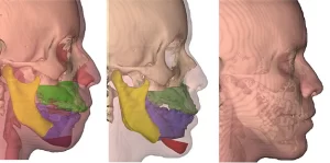 Cirurgia Ortognática Cirurgia Ortognática