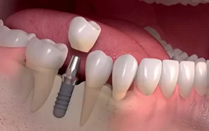 Implantes dentários Implantes dentários