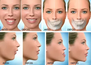 Cirurgia Ortognática Cirurgia Ortognática