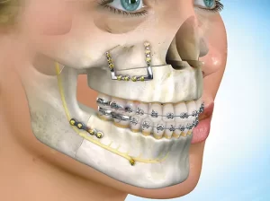 Cirurgia Ortognática Cirurgia Ortognática